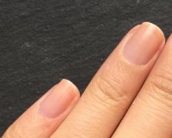Точки на ногтях — причины появления, какие болезни вызывают симптом, методы лечения и профилактики Почему появляются вмятины на ногтях рук