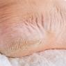 Причины и лечение сухости кожи на пятках